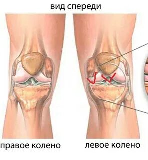 Болит правая сторона левого колена