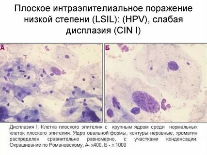 Интраэпителиальное поражение эпителия