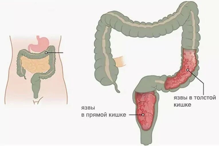 Колет внутри. Язвини колить толскишка. Язвенный колит двенадцатиперстной кишки. Язвенный колит кишечника симптомы. Некротический язвенный колит.