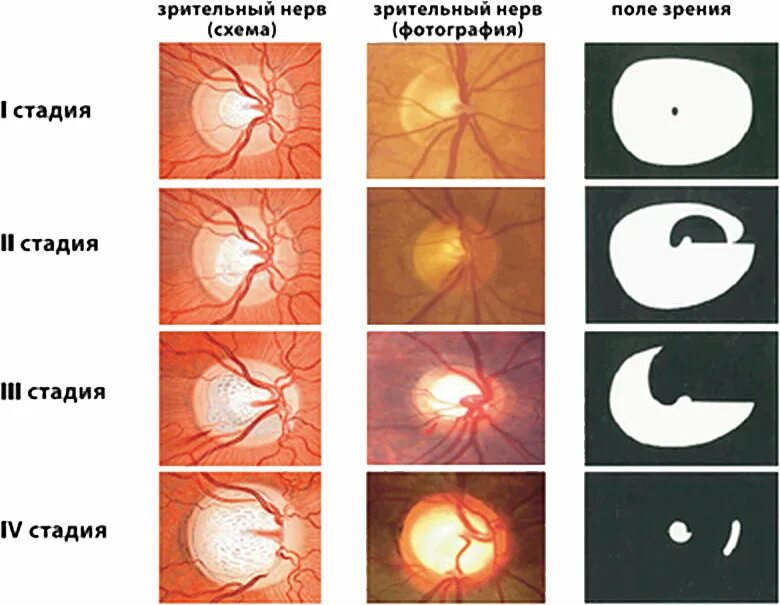 Атрофия зрительного нерва Лебера. Атрофия зрительного нерва классификация. Атрофия зрительного нерва Лебера этиология. Открытоугольная глаукома глазное дно. Глаукома латынь