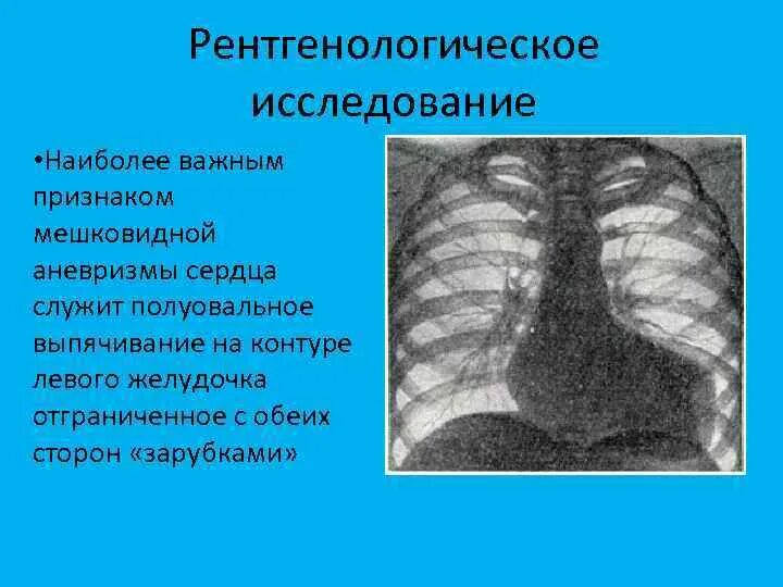 Аневризма сердца что это такое симптомы. Мешковидное выпячивание сердца. Мешковидная аневризма сердца. Аневризма сердца рентген.