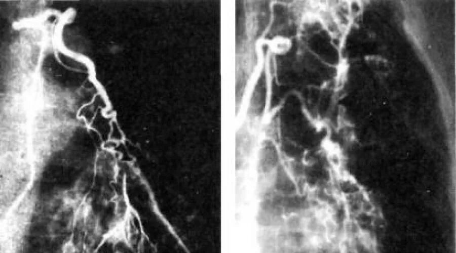 Легочная язва. Профузное легочное кровотечение. Рентген легочное кровотечение туберкулез. Бронхиальная артериография легочное кровотечение. Легочное кровотечение при туберкулезе рентген.
