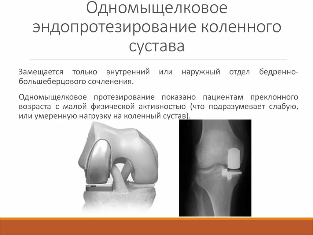 Протезирование суставов по квоте. Эндопротез коленного сустава stryker. цементное эндопротезирование коленного сустава. схема эндопротеза коленного сустава. схема операции эндопротезирования коленного сустава.