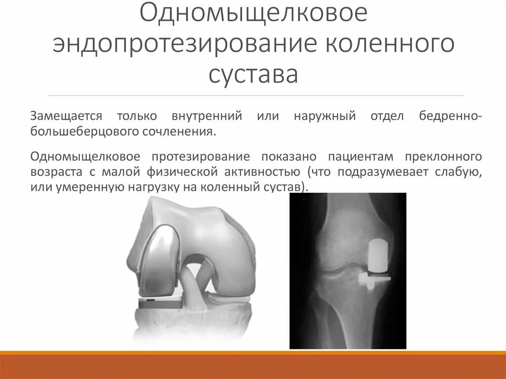 Одномыщелковое эндопротезирование коленного рентген. Эндопротез мыщелка коленного сустава. Тотальное эндопротезирование коленного сустава DEPUY. Одномыщелковое эндопротезирование тазобедренного сустава.