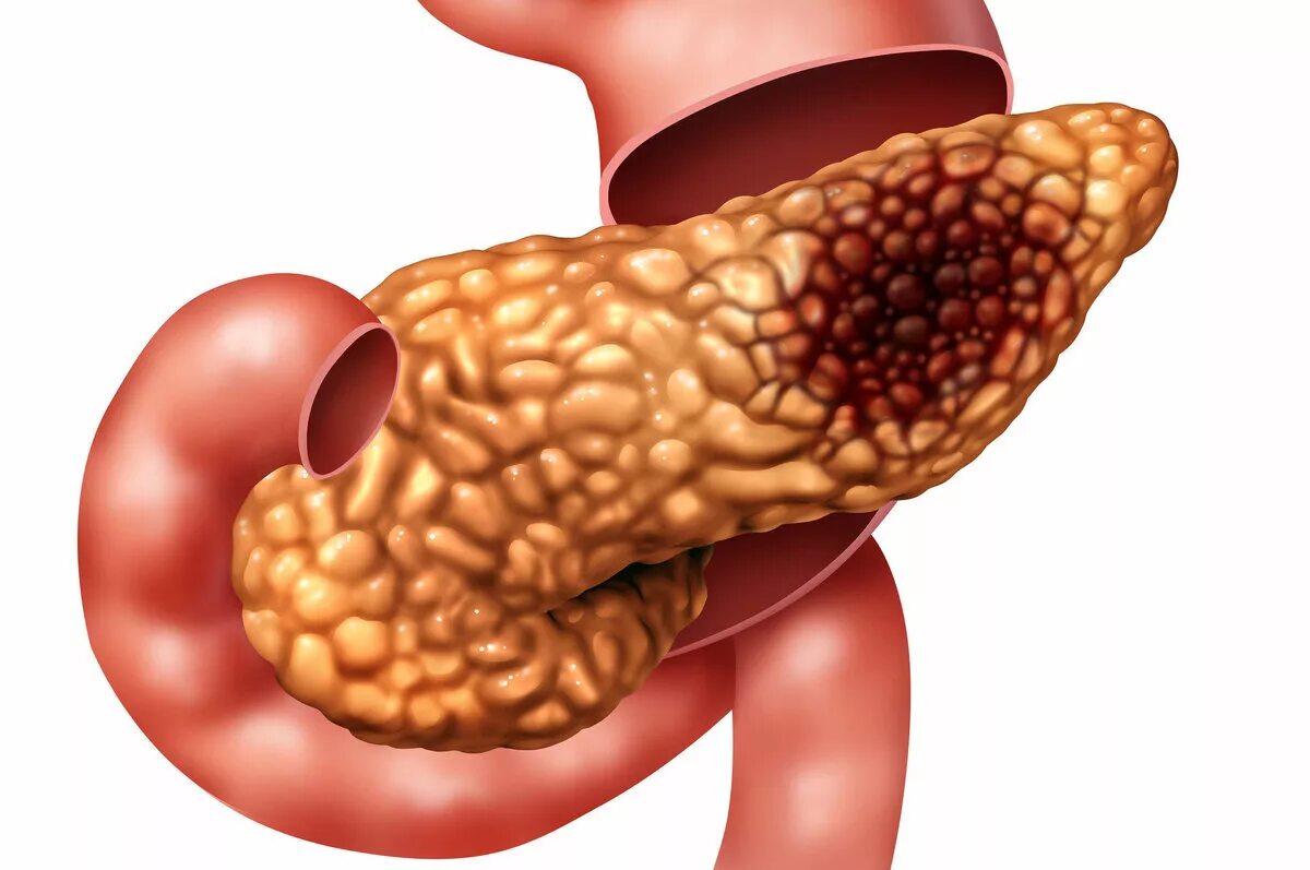 Панкреатит воспаление поджелудочной железы. Кистофиброз поджелудочной железы. Острый билиарный панкреатит. Фибролипоматоз поджелудочной. Хронический холецистит поджелудочной железы