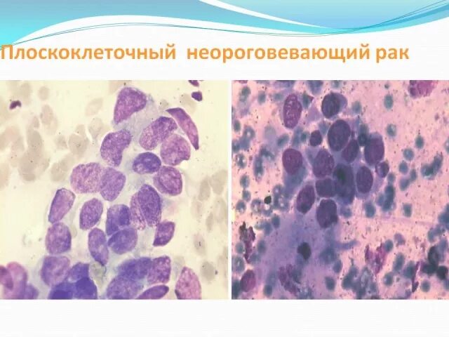 Плоскоклеточная карцинома цитология. Плоскоклеточный неороговевающий. Цитологическая картина плоскоклеточной карциномы. Неороговевающая эпидермоидная карцинома. Плоскоклеточный неороговевающий рак шейки