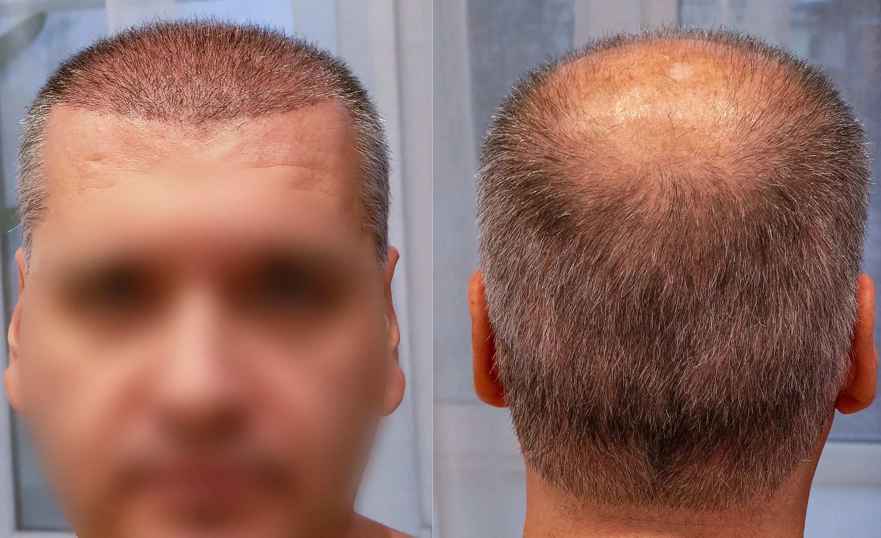 3000 Grafts Hair Transplant l Results, Cost 2025