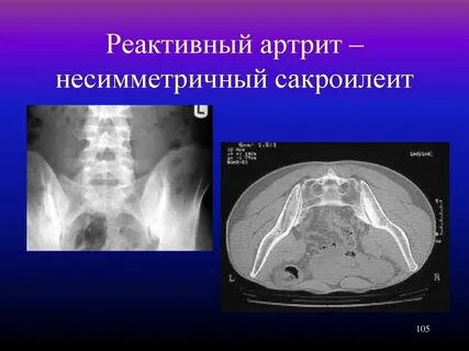 Артрит сакроилеит