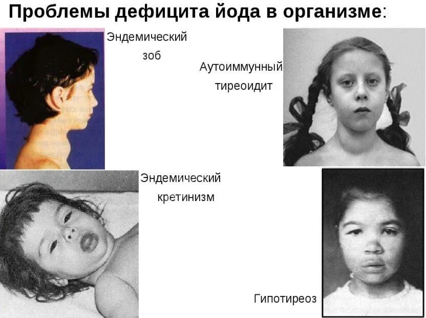 образования щитовидной железы у детей