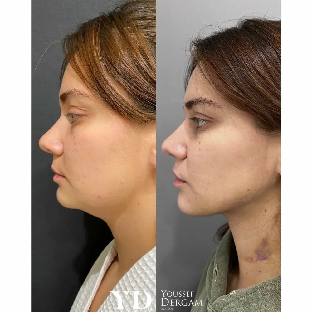 Клиника ЕЛЕНА/косметология/пластическая хирургия Процедура #FaceTite (липосакция