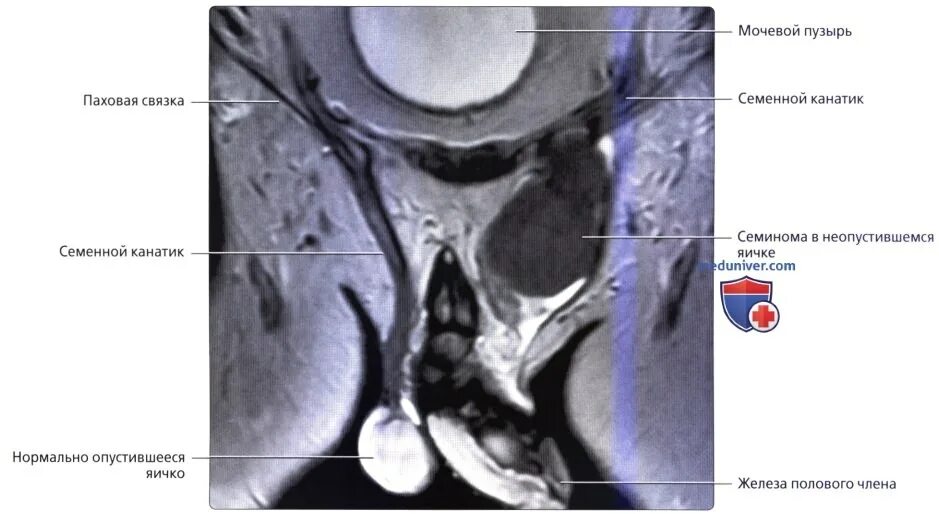 Опухоль придатка яичка мрт.