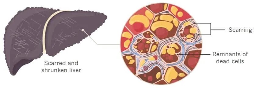 Процесс распада клеток мозга. Жировой гепатоз печени патанатомия. Промежуточные продукты распада белков. Жировое перерождение клетки. Жировое перерождение клетки.