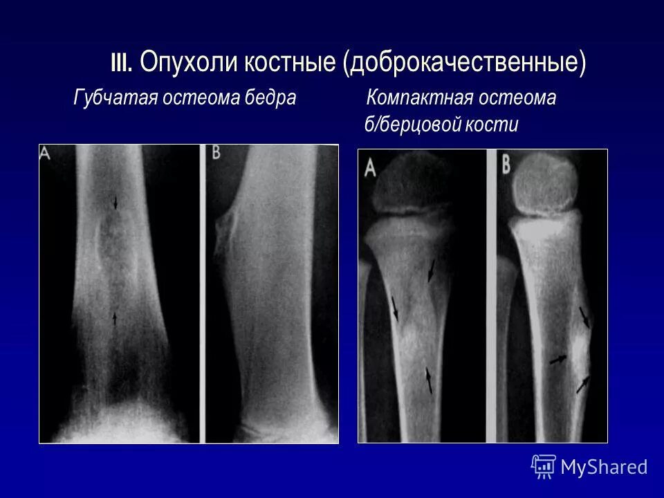 Доброкачественные опухоли у детей. Компактная остеома бедренной кости. Доброкачественные новообразования костей остеоид остеома. Компактная остеома большеберцовой кости. Опухоли большеберцовой кости остеома.