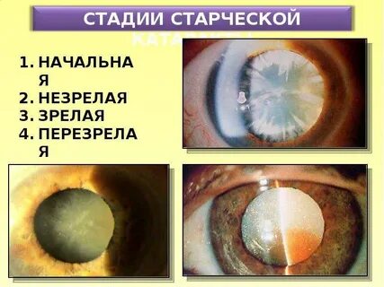 Стадии катаракты