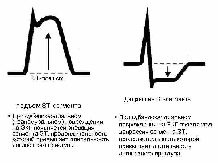 Депрессия сегмента st