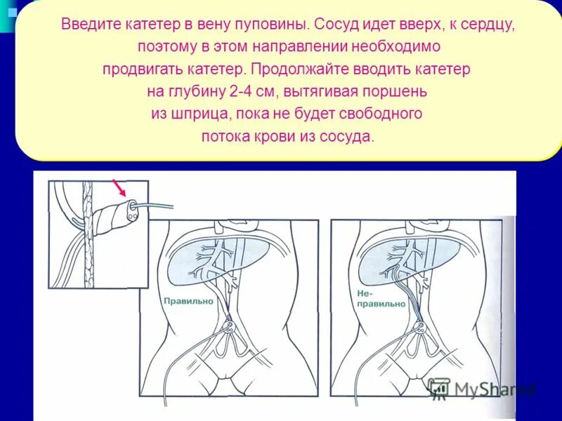 Вводят через катетер. Техника катетеризации пупочной вены. Катетер для катетеризации пупочной вены. Катетеризация пупочной вены у новорождённых. Катетеризация пупочной вены методика.