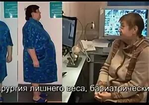 Операция по уменьшению желудка ростов. Операция по уменьшению желудка. операция по уменьшению желудка для похудения. резекция желудка для похудения. бандажирование желудка шрамы.