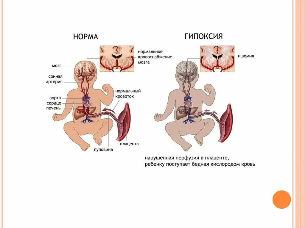 Нормальному кровообращению. Маточно плацентарный кровоток при хронической гипоксии. Показания к кесареву нарушение кровотока 1 степени. Кровоток между мамой и малышом.