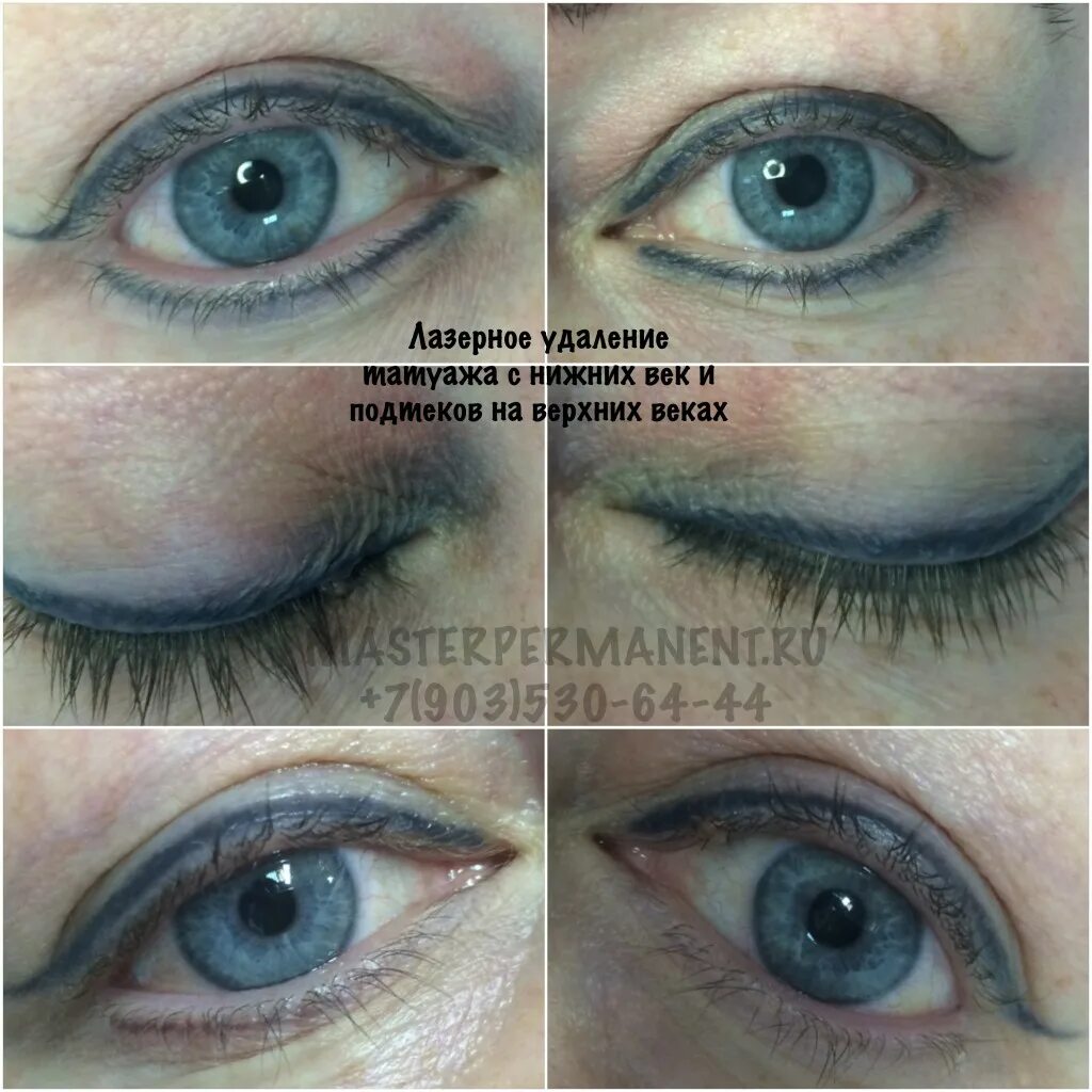 удаление татуажа век отзывы