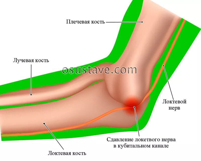 Локтевой нерв в локтевом суставе. Болит косточка на локтевом суставе. Косточка на локтевом суставе. Внутренняя сторона локтевого сустава. Локтевой изгиб