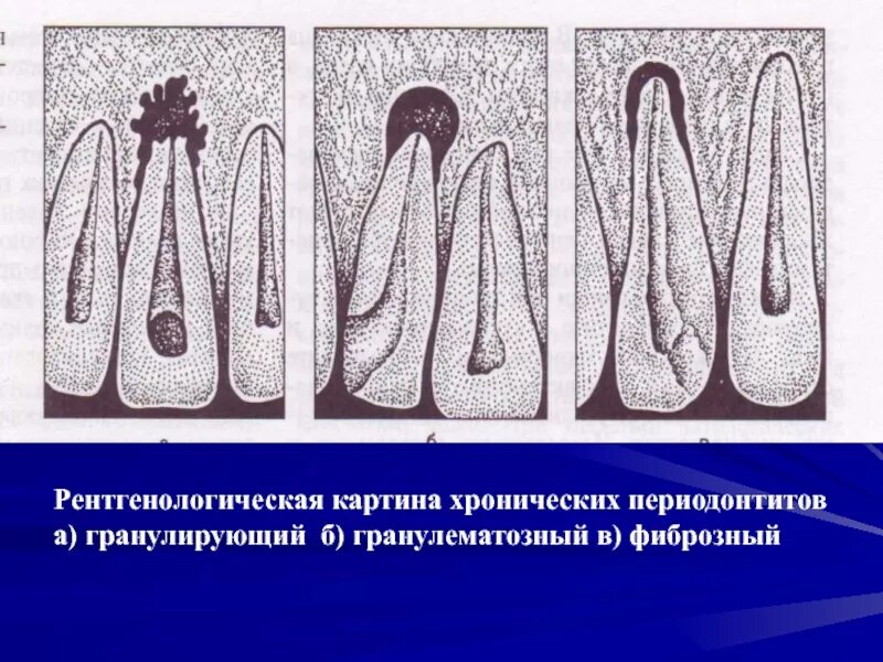 Фиброзный периодонтит. Острый гранулематозный периодонтит. Хронический периодонтит гранулирующий гранулематозный фиброзный. Хронический апикальный гранулирующий периодонтит. Хронический верхушечный гранулирующий периодонтит.