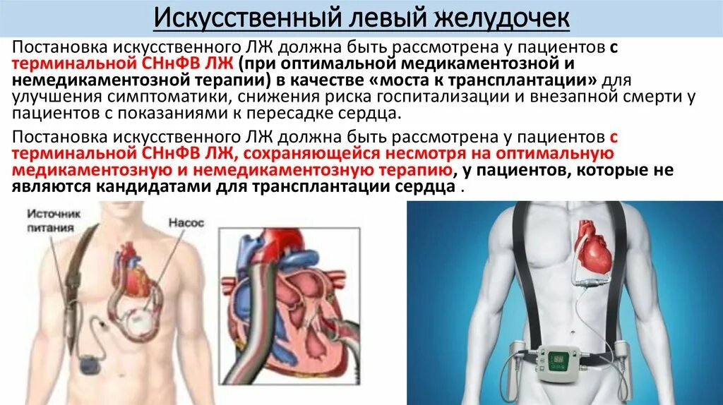 Сколько весит искусственный левый желудочек