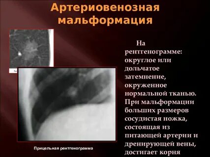 Артериовенозная мальформация