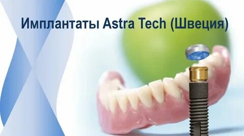 Astra имплант отзывы