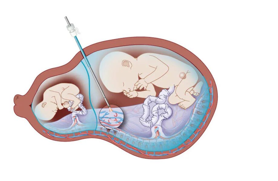 Фето фетальный синдром. Фето-фетальный трансфузионный синдром УЗИ. Редукция эмбриона при многоплодной беременности. Фето фетальный трансфузионный синдром при двойне. Фетальная хирургия