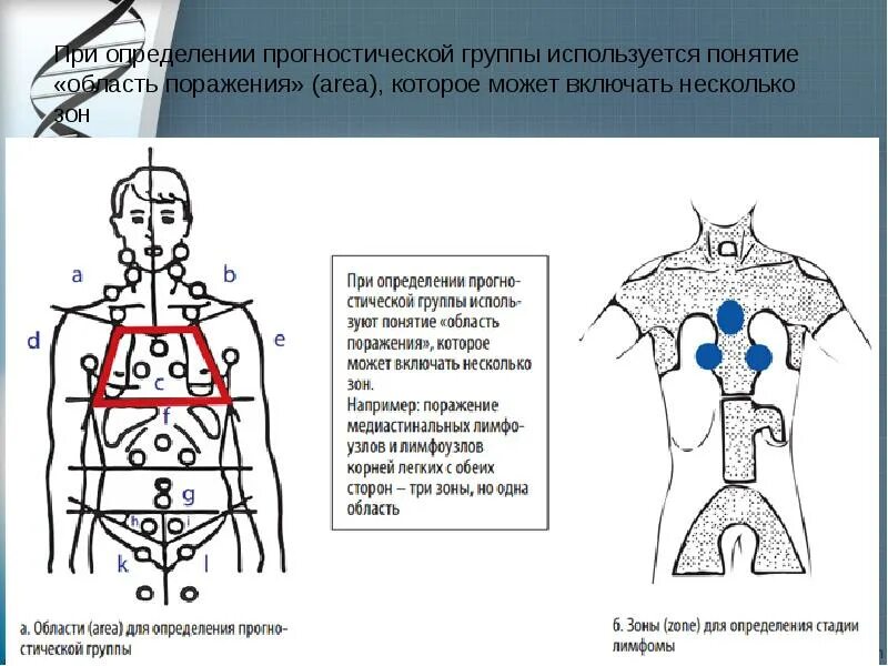 Метастазы при лимфоме