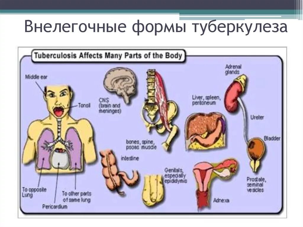 Туберкулез внелегочной локализации. Внелегочные формы туберкулеза. Веелегочной туберкулёз. Локализация туберкулеза.