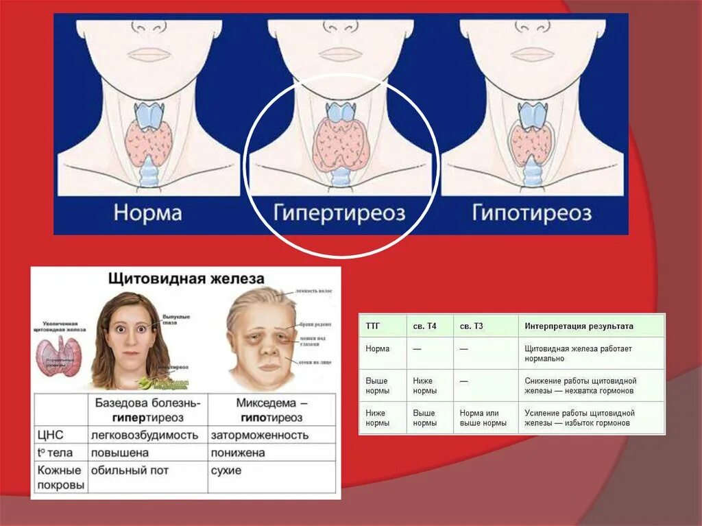 Какой врач железы. Снижение работы щитовидной железы. Крупный узел и нормально  функционирующая щитовидка. Легковозбудимость это. Где лучше удалить щитовидную железу в Донецке ДНР.