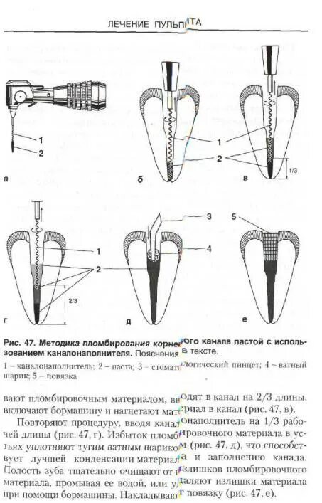 Методы пломбирования корневых. Методика пломбирование гуттаперчевыми штифтами. Комбинированные методики пломбирования корневых каналов зуба. Комбинированный метод пломбирования корневого канала резорциновый. Пломбировка корневого канала каналонаполнителем.