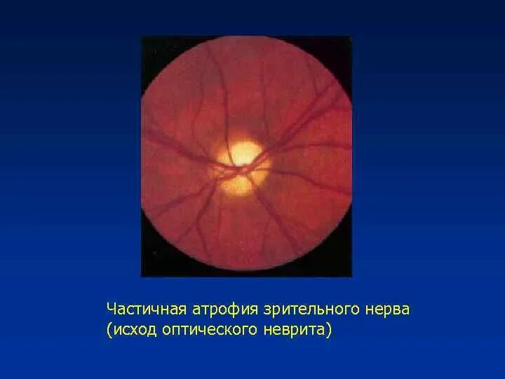 Тип зрительного нерва. Атрофия зрительного нерва Лебера генетика. Омертвление зрительного нерва. Неврит зрительного нерва окт. Перипапиллярная атрофия зрительного.