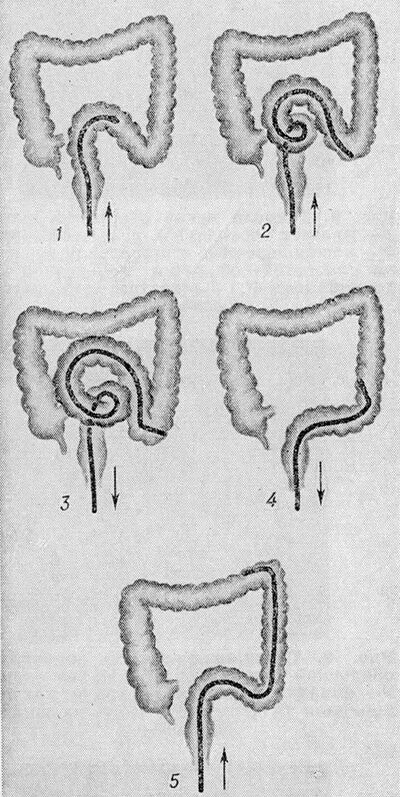 Исследование прямой и сигмовидной кишки. Схема кишечника долихосигма. Альфа петля сигмовидной кишки. Долихосигма кишечника и колоноскопия.
