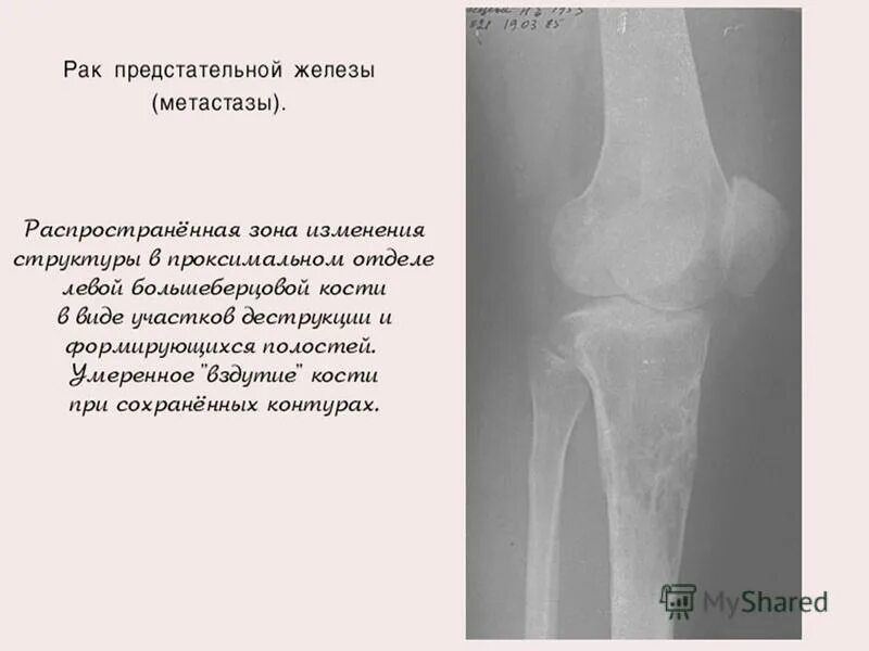 Метастазы в кости при раке предстательной