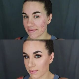 Как скрыть прыщи без косметики