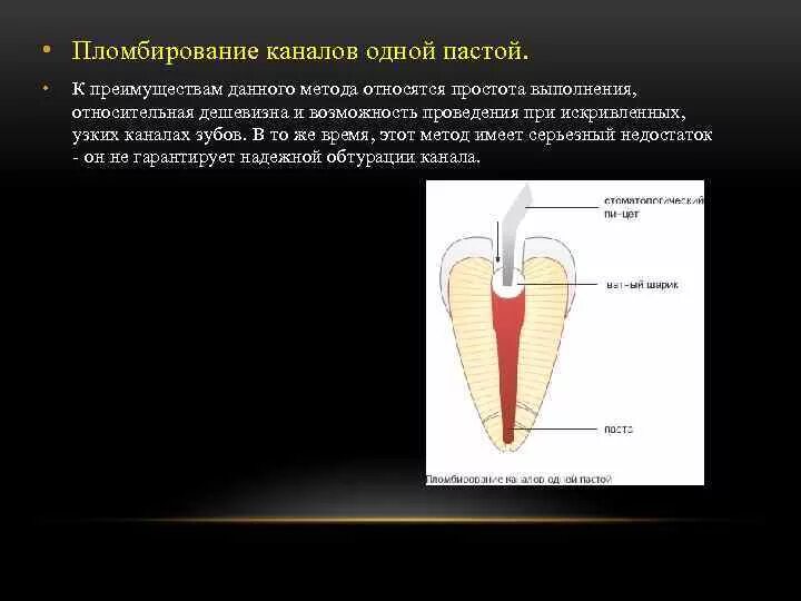 1 корневой канал. Метод одной пасты пломбирования каналов. Классификация методик пломбирования корневых каналов. Методы пломбирования корневых каналов материалы. Комбинированные методики пломбирования корневых каналов зуба.