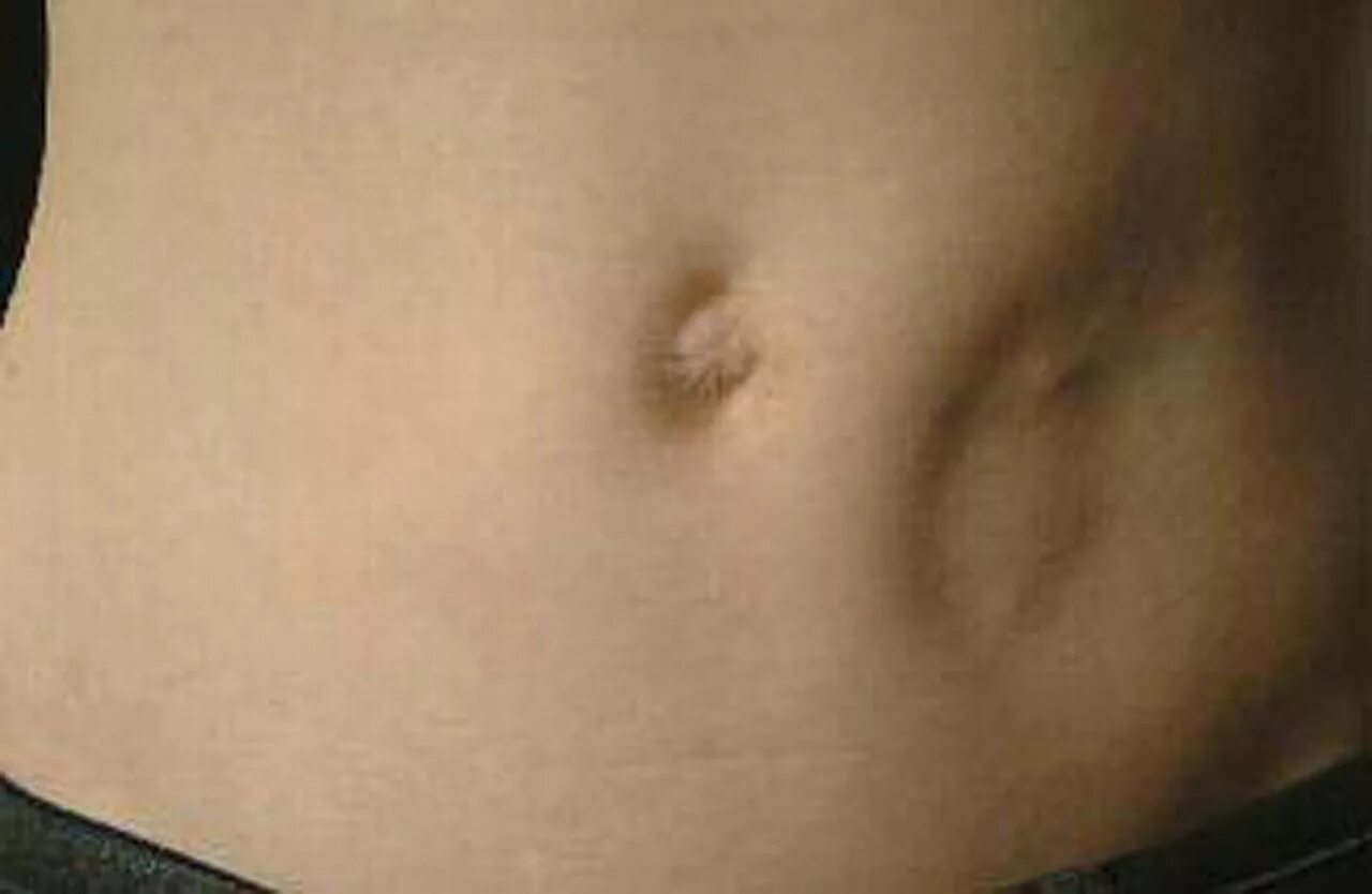 растянутая кожа над пупком. Stomach close up. грыжа спигелиевой линии живота. пупочная грыжа белой линии. кожа над пупком.