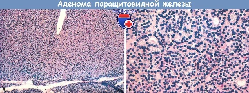 Тиреотропный гормон органы мишени. Липоаденома пращитовидной железы. Паращитовидная аденома форум. Паращитовидная железа операция. Паращитовидные железы гормоны заболевания.