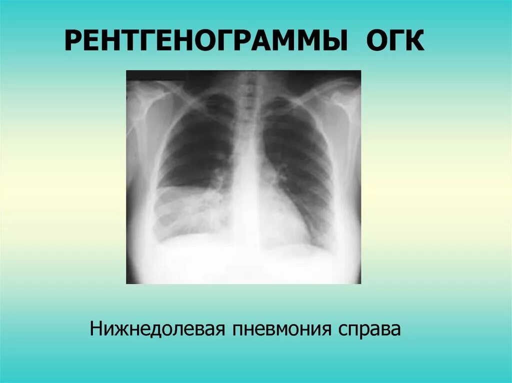 Пневмония в правой нижней доле. Правосторонняя нижнедолевая очаговая пневмония рентген. Правосторонняя очаговая пневмония рентген. Правосторонняя нижнедолевая пневмония рентген. Нижнедолевая пневмония рентген.