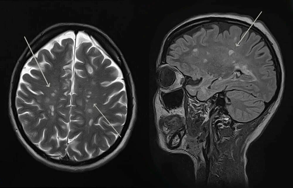Склероз мозга. Мозжечковая форма рассеянного склероза. Рассеянный склероз на мрт головного мозга. Рассеянный склероз на кт головного мозга. Рассеянный склероз мрт головного мозга с контрастом.