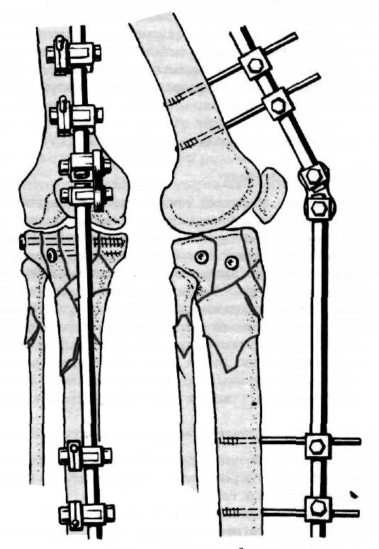 Перелом большеберцовой кости остеосинтез. Перелом бедра аппарат Илизарова. Остеосинтез мыщелка большеберцовой кости операция. Остеосинтез переломов мыщелков большеберцовой кости.