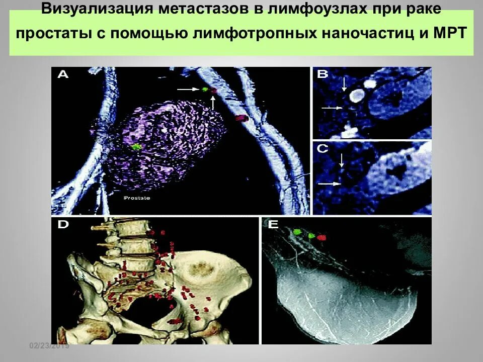 Метастатические лимфоузлы. Метастазирование в лимфоузлы. Метастазы в лимфатические узлы. Метастазы в легких лимфоузлы