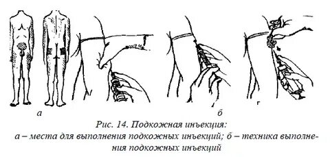 Как правильно делать подкожные инъекции
