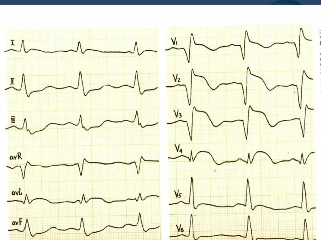 Ишемия передней стенки. Ишемия миокарда на ЭКГ. Переднеперегородочный инфаркт миокарда на ЭКГ. Инфаркт миокарда с аневризмой ЭКГ. Аневризма передней стенки ЭКГ.