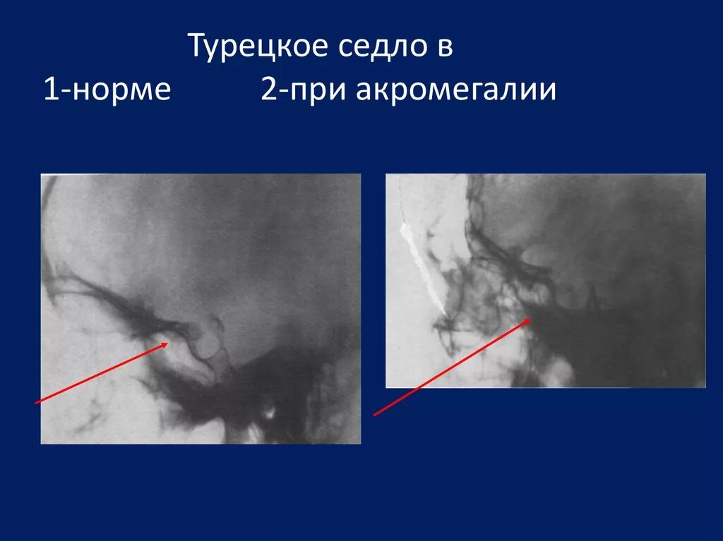 Образование турецкого седла. Рентгенограмма турецкого седла патология. Турецкое седло анатомия. Анатомия турецкого седла рентген. Опухоль турецкого седла рентген.