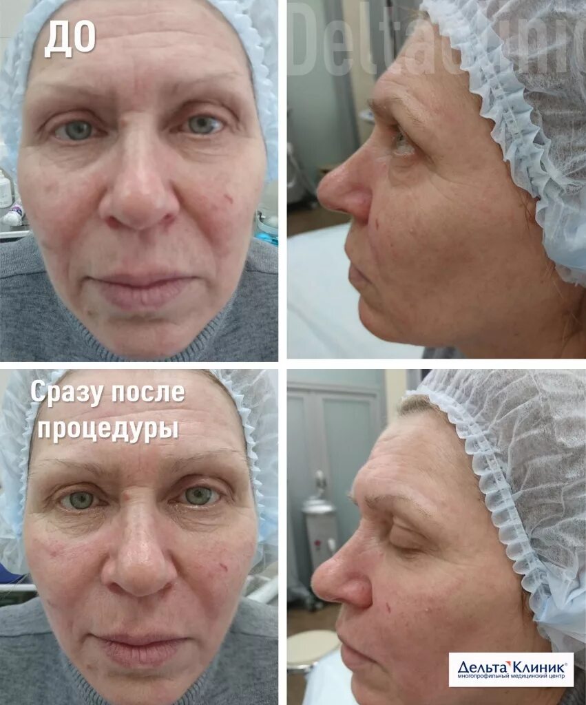 Альтера Систем (Ulthera System): фото, безоперационная подтяжка лица