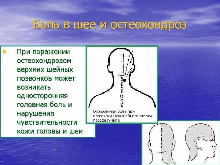 Давление при шейном остеохондрозе симптомы. Локализация боли при шейном остеохондрозе. остеохондроз головные боли.
