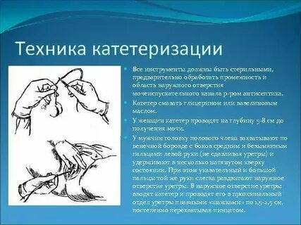 Постановка катетера манипуляция